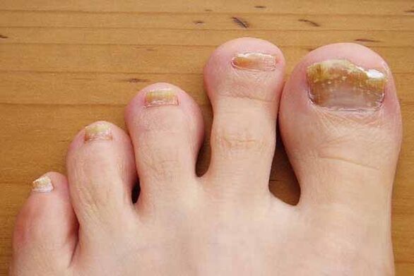 Appearance of toenails affected by fungi