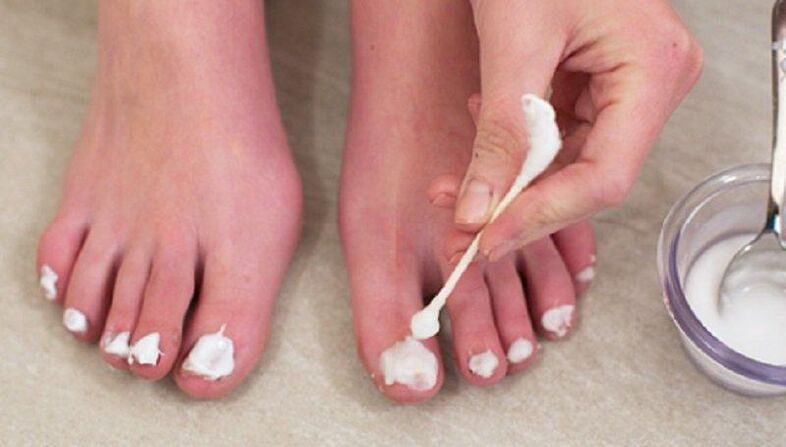 Traditional treatment for toenail fungus