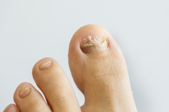 Fungus nail