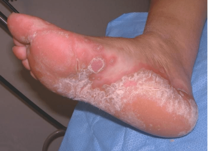 Determine the feet of the foot
