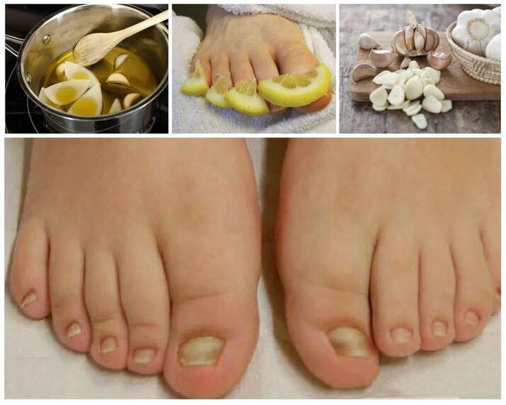 Fungus nail