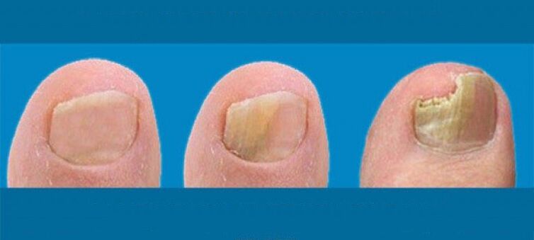 Nail Fungus Development
