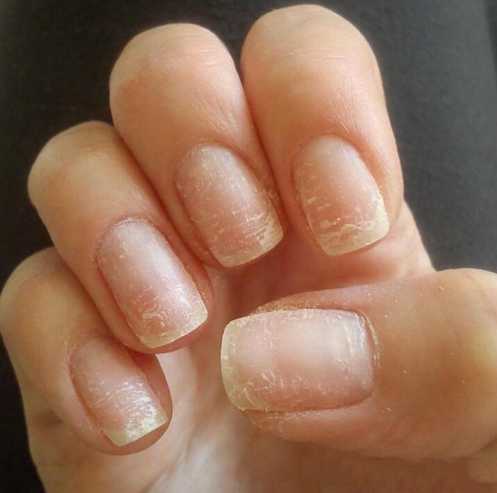 Treatment and prevention of fungi