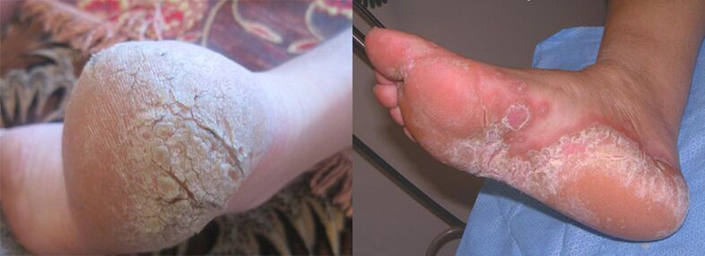Feet affected by fungi