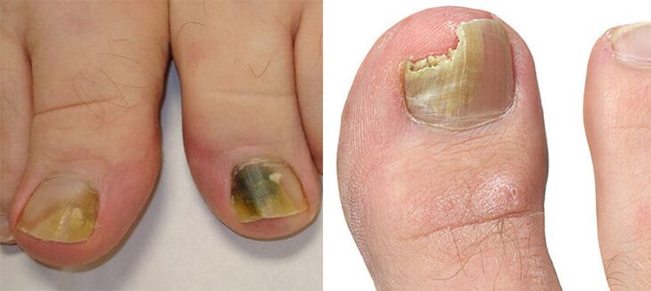 ONTIHYCOMYCOSIS - Destruction of nails with fungi
