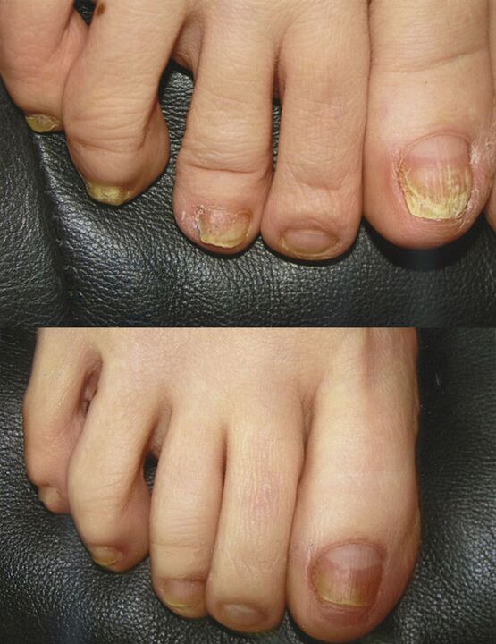 The use of borose acid to treat fungus