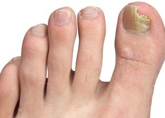 Symptoms Fungi nail
