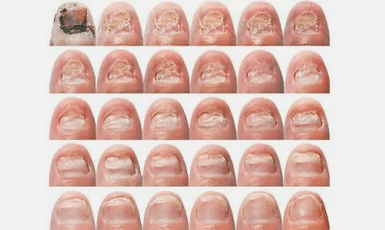What does nail fungus look like