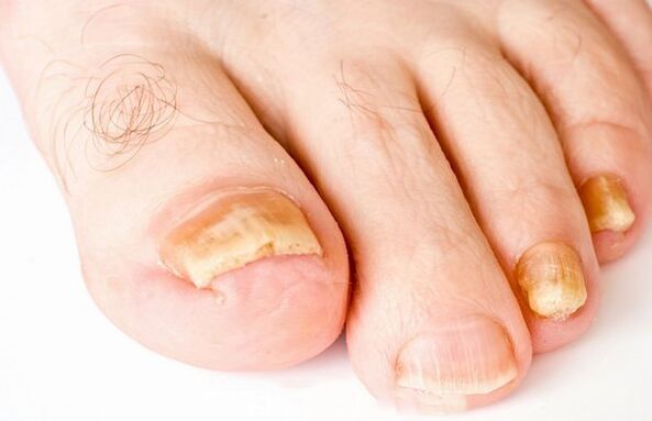 Fungus nail
