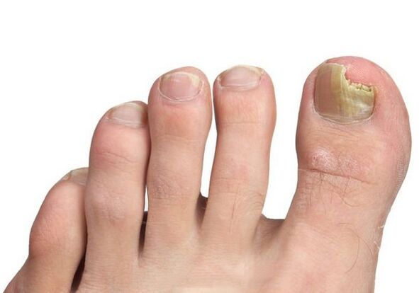How is fungus infection
