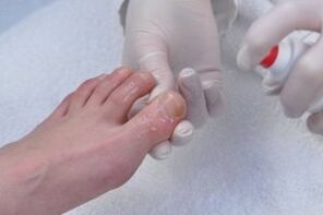 treatment of toenail fungus