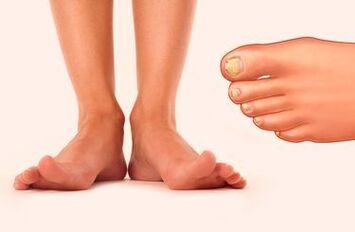 Fungus nail