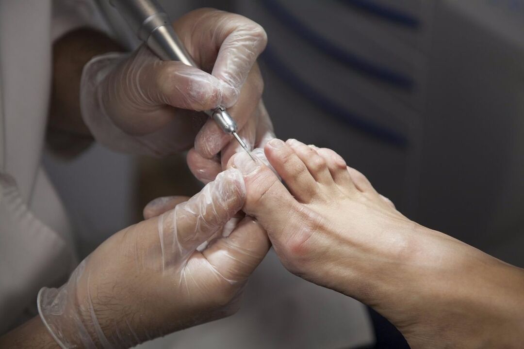 professional treatment of toenail fungus