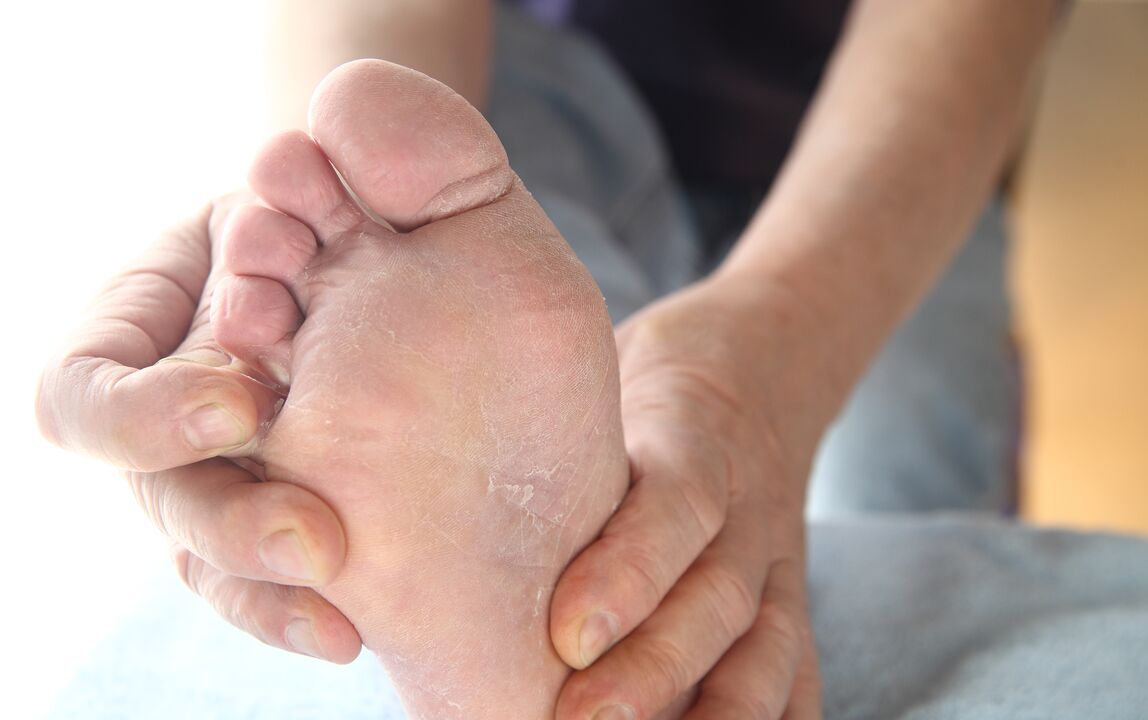 peeling skin with foot fungus