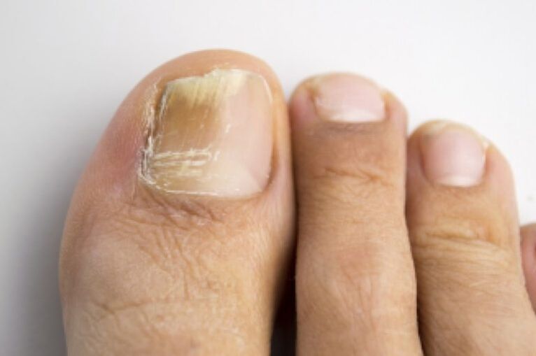 Fungal toenail infection