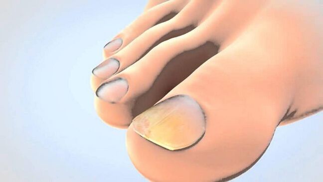 Fungal toenails