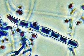 The causative agent of nail fungus under the microscope