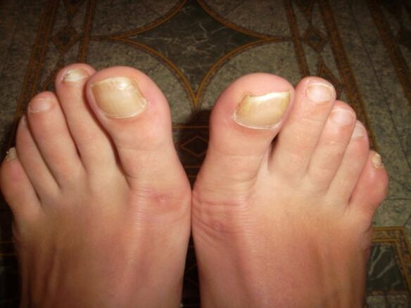 Fungal infection of the nail of the big toe