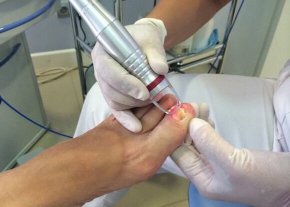 Laser treatment of nail fungus on the big toe