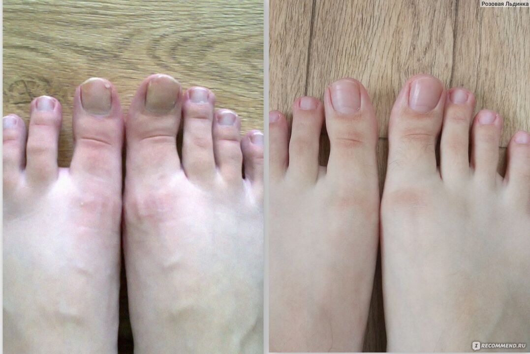 before and after anti-fungal treatment with Fungostop Plus cream